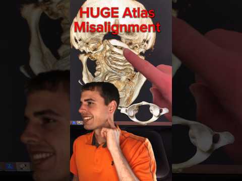 HUGE Atlas Misalignment 🛑 #migraines #brainfog #concussions #neckpain #uppercervicalchiropractor