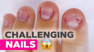 Can You Grow Back Bitten Nails | Extreme Nail Makeover