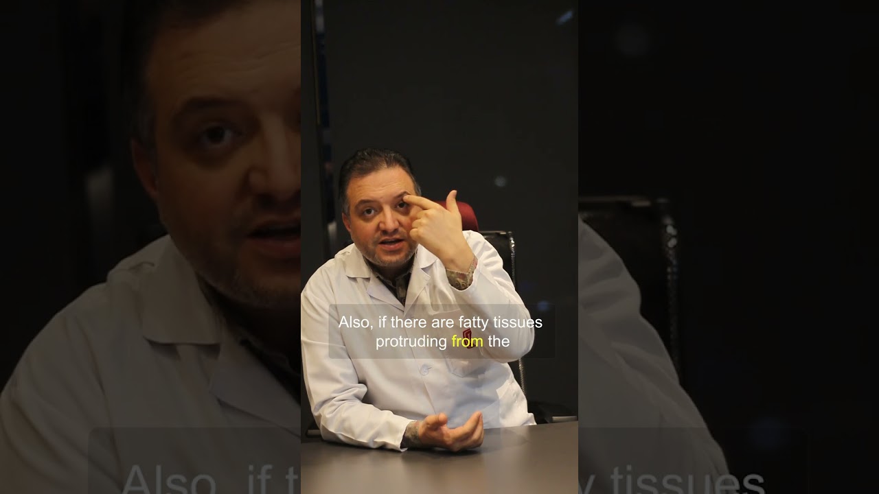 Göz Kapağı Estetiği Nedir?