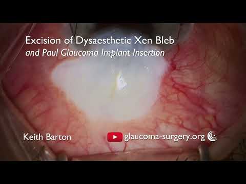 XEN bleb excision and Paul Glaucoma Implant insertion showing anterior segment surgery and conjunctival closure
