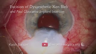 Removal of a Dysaesthetic Overhanging Xen Gel Implant Bleb and Insertion of a Paul Glaucoma Implant