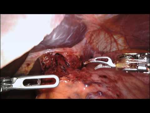 Robotic Xi Heller Myotomy