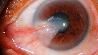 Pterygium: Uncovering Causes and Symptoms#eyedoctor