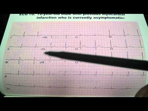 Previous Myocardial Infarction EKG ECG Uri Ben Zur MD