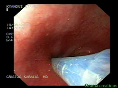 Fistula After Sleeve Stomach Resection, Stent