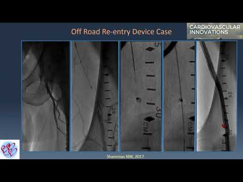 CTO Devices for SFA Occlusion - Nicolas Shammas, MD