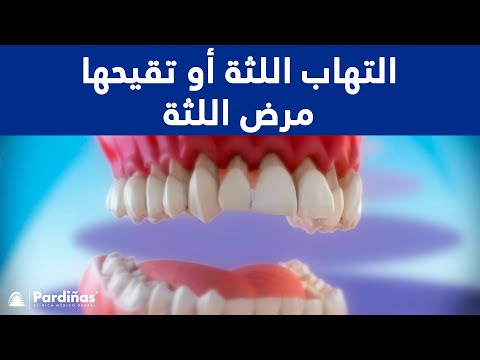 التهاب اللثة أو تقيحها – مرض اللثة ©