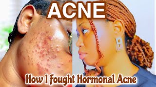 HOW TO GET RID OF HORMONAL ACNE FOREVER| 5 EFFECTIVE INGREDIENTS THAT WORKS MAGIC ON ACNE