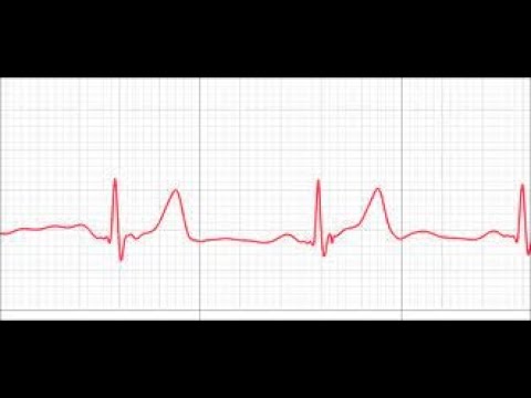 ECG Basics Part 2
