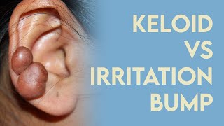 Keloid or Irritation Bump? How to fix "piercing bumps"