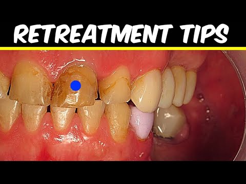 Root Canal Retreatment Tips