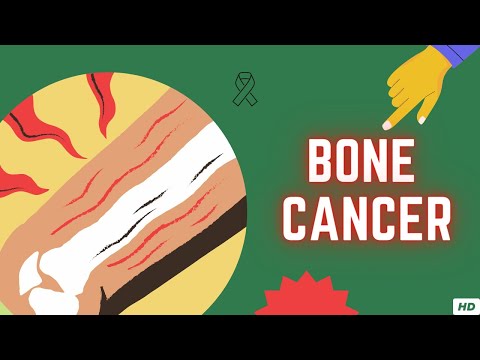 Bone Cancer, Causes, Signs and Symptoms, Diagnosis and Treatment.