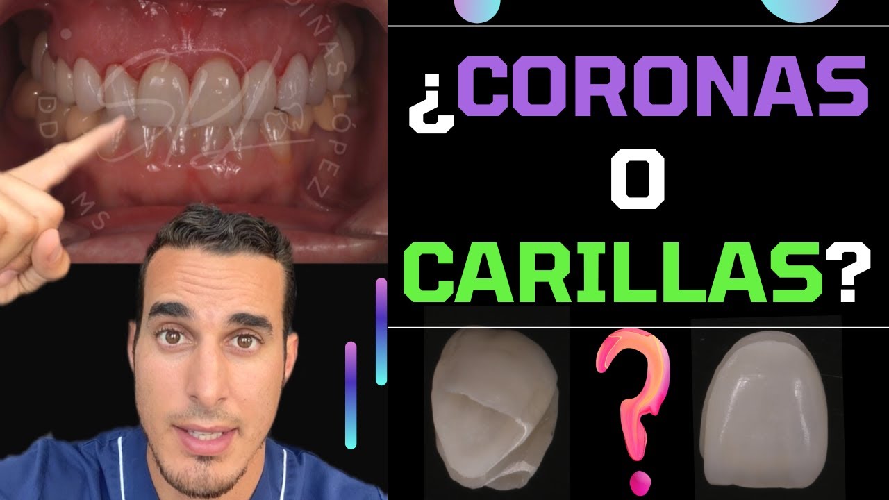 ¿CORONAS o CARILLAS DENTALES - Cuál es MEJOR y en qué se DIFERENCIAN - #shorts