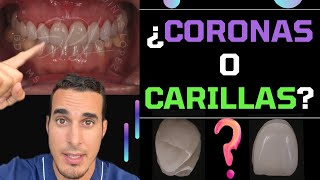 ¿CORONAS o CARILLAS DENTALES - Cuál es MEJOR y en qué se DIFERENCIAN - #shorts