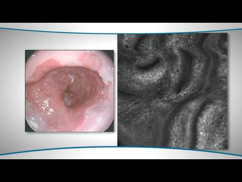 Learn About Confocal Microendoscopy