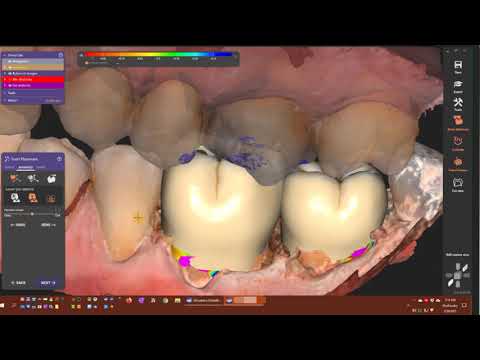 Instant Anatomic Morphing in exocad dentalCAD v3.0 Galway
