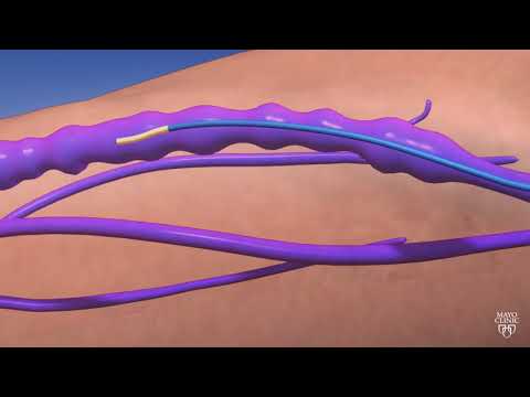 Guiding Light: An Animated Journey through Endovenous Thermal Ablation
