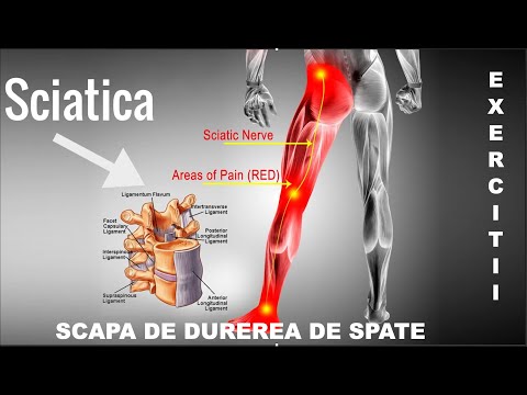 Inflamatia nervului sciatic Pagina 8