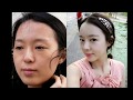 탑클래스성형외과 topclass plastic surgery 밋밋한 얼굴에서 세련된 입체감 얼굴로 변화