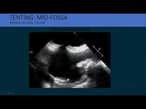 MitraClip: History, Indications, Work up and Future Directions