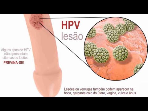 extirparea mucoasei papiloma