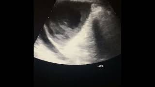 Case 230 : Splenic Abscess