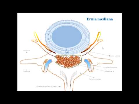 Appeso al collo talpe rimedi popolari di trattamento Sostituzione del ginocchio chirurgia aspettare molto di quote