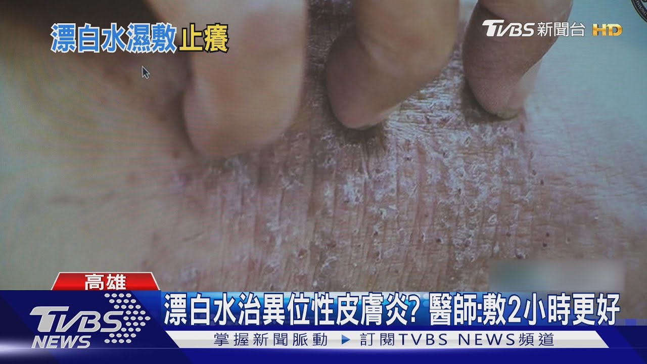 係金ㄟ!漂白水治療異位性皮膚炎 醫師、病友說話了