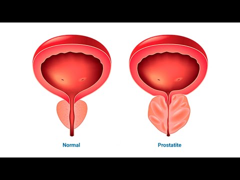 02 sintomas que podem ser inchaço na próstata