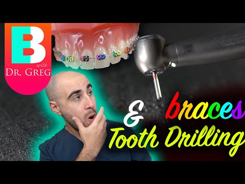 Braces & Teeth Drilling?! 5 Reasons Why
