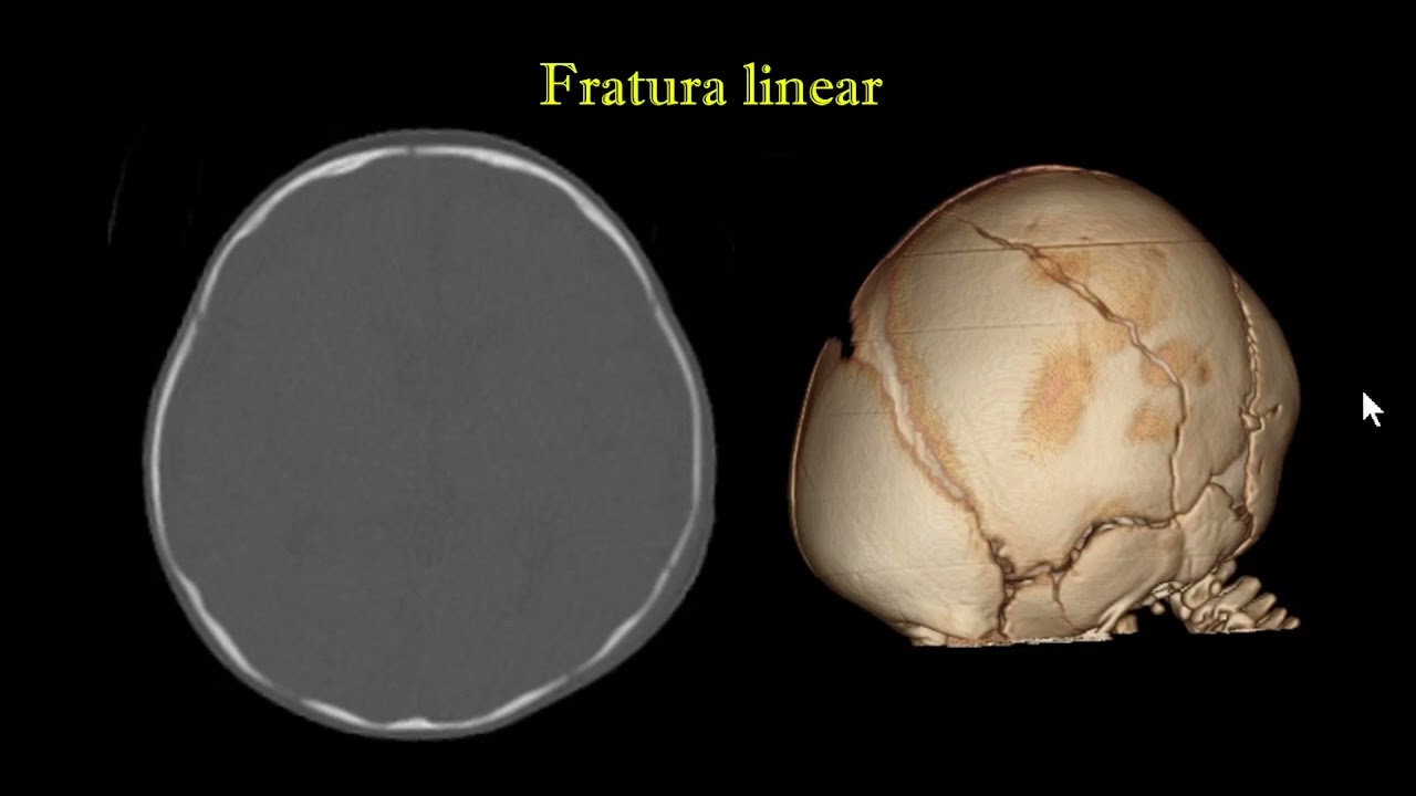 Fratura de crânio ou sutura ?