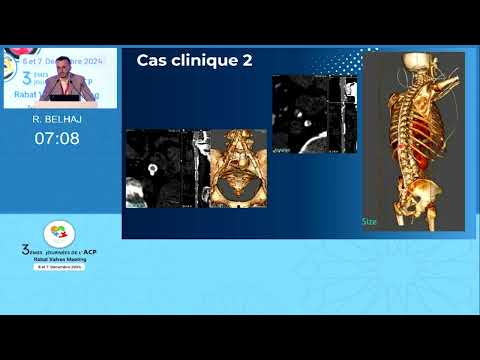 Sténose aortique et Coronaropathie