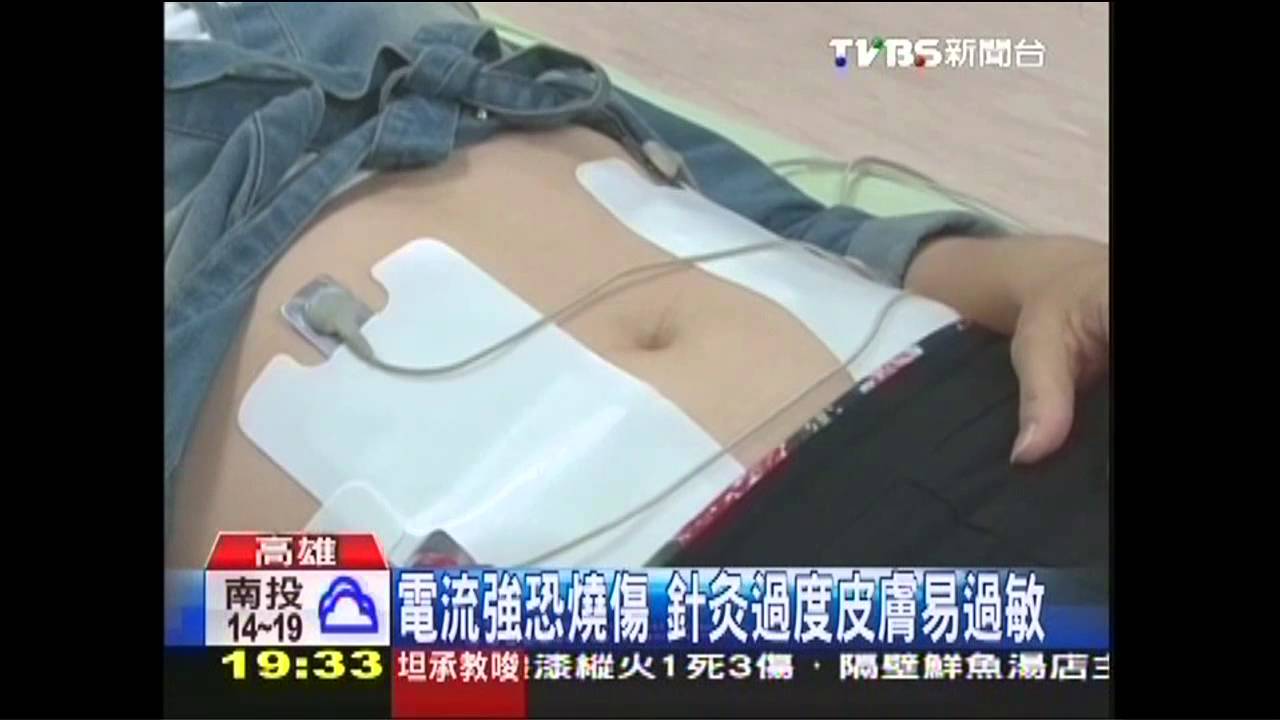 冬天腹臀腿最易肥! 電療、針灸局部瘦夯