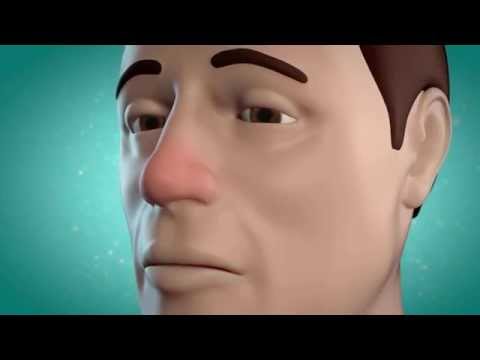 Wirkanimation - so entsteht Schnupfen