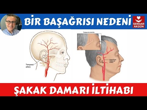 Bir baş ağrısı nedeni?, Şakak Damarı İltihabı, Sağlık, Prof.Dr.Serdar Akgün,