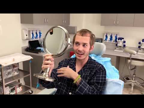 Best FUE Hair Transplant in Los Angeles, California.