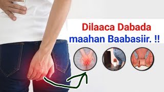 Download lagu Dilaaca Dabada ( anal fissure ) ee Lagu qaldo Baabasiirka ( hemorrhoids ) sida loo kala Saaro ✅✅✅ mp3
