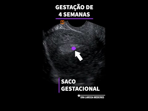 4 SEMANAS | Ultrassom Obstétrico