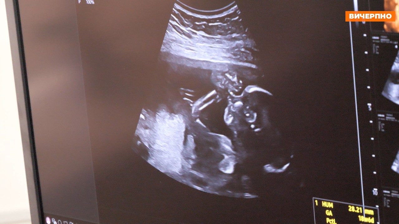 Сучасний УЗД-апарат запрацював у Черкаському обласному перинатальному центрі