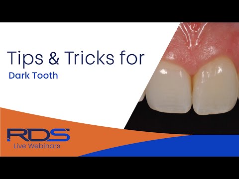 Wskazówki dotyczące wybielania zębów martwych przebarwionych