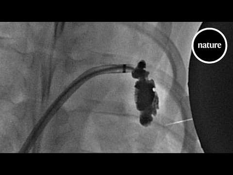 Can Magnetic Gel Prevent Strokes?