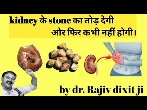 Rajiv dixit- Kidney stone treatment || pathri ka ilaj rajiv dixit || kidney stone treatment in hindi Video