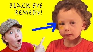 A Remedy for Bruising, Black Eyes, and Swelling (Natural, Quick, Effective)