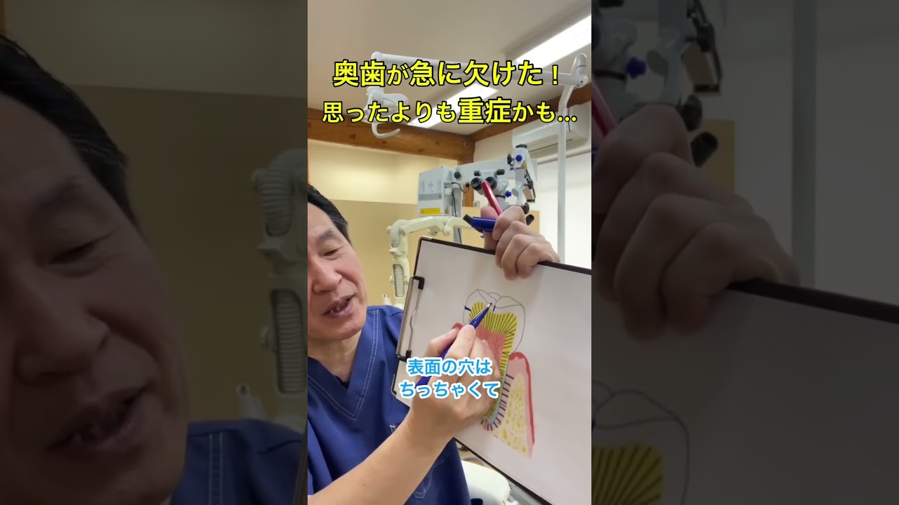 奥歯が急に欠けた！思ったよりも重症かも…