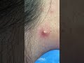 #shorts Pimple Popping by Dermatologist Dr. Timothy Jochen | CONTOUR DERMATOLOGY