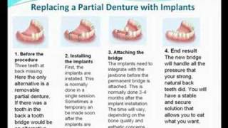 preview picture of video 'Dental Implants| and Dentures- Glen Ellyn (near Chicago)'
