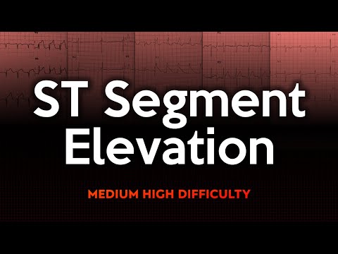 ST-Segment Elevation ECG Quiz: Medium to High Difficulty