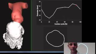 When & how to replace the pulmonary valve – Dr Phil Roberts