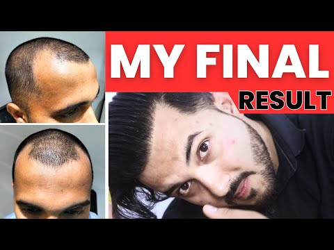 Journey Of My Full Hair Transplant Result After 1 Year...