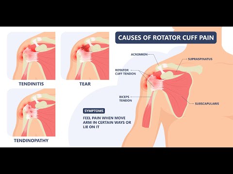 Video thumbnail: How a rotator cuff repair works